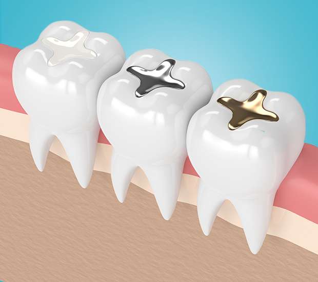 Canon City Composite Fillings