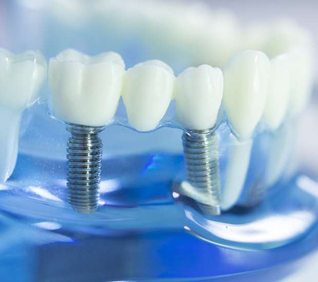 Canon City Dental Implants