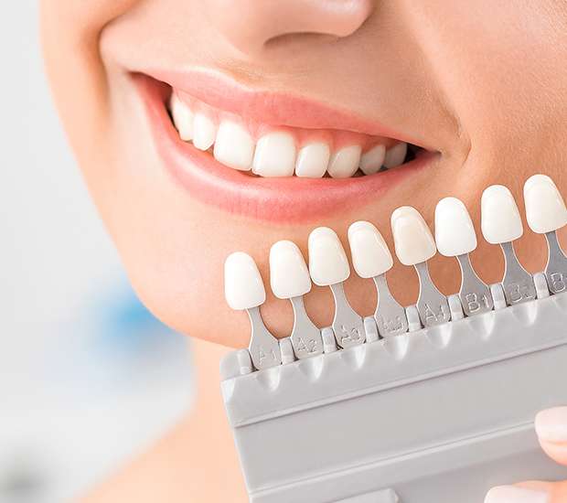 Canon City Dental Veneers and Dental Laminates