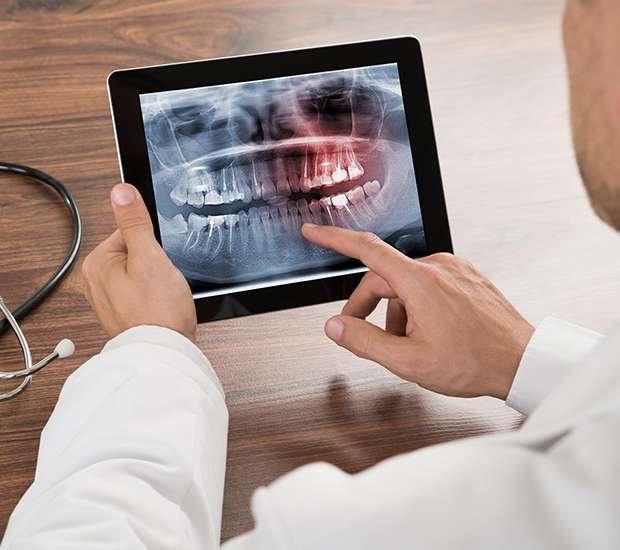 Canon City Types of Dental Root Fractures